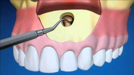 apikotomija-operacija-ciste-na-zubu-prikaz