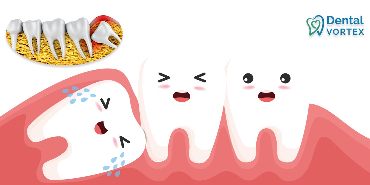 Ilustracija zašto je vađenje umnjaka neophodan zahvat kada nema mesta za zube u vilici.