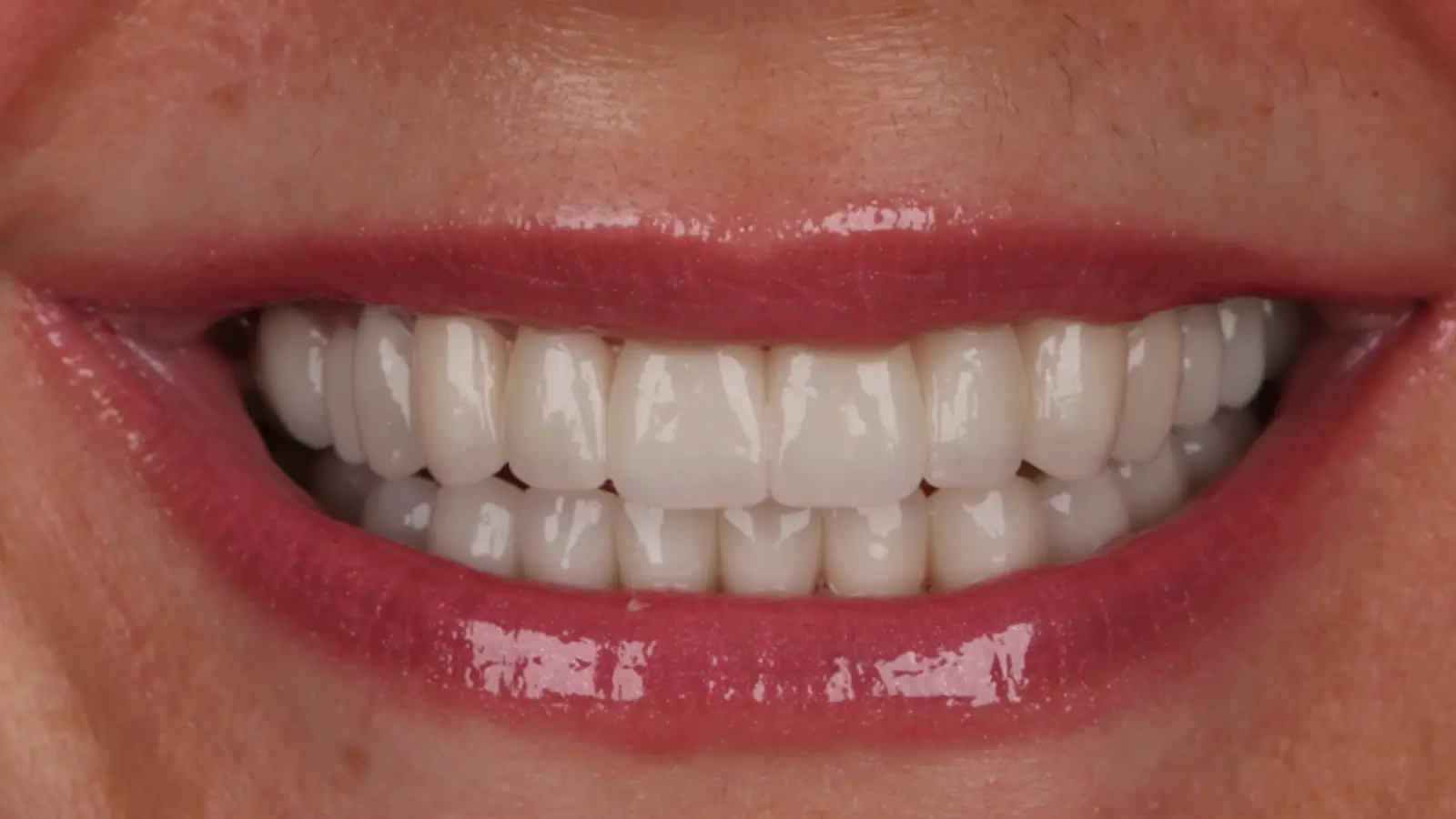 Hollywood smile - after treatment