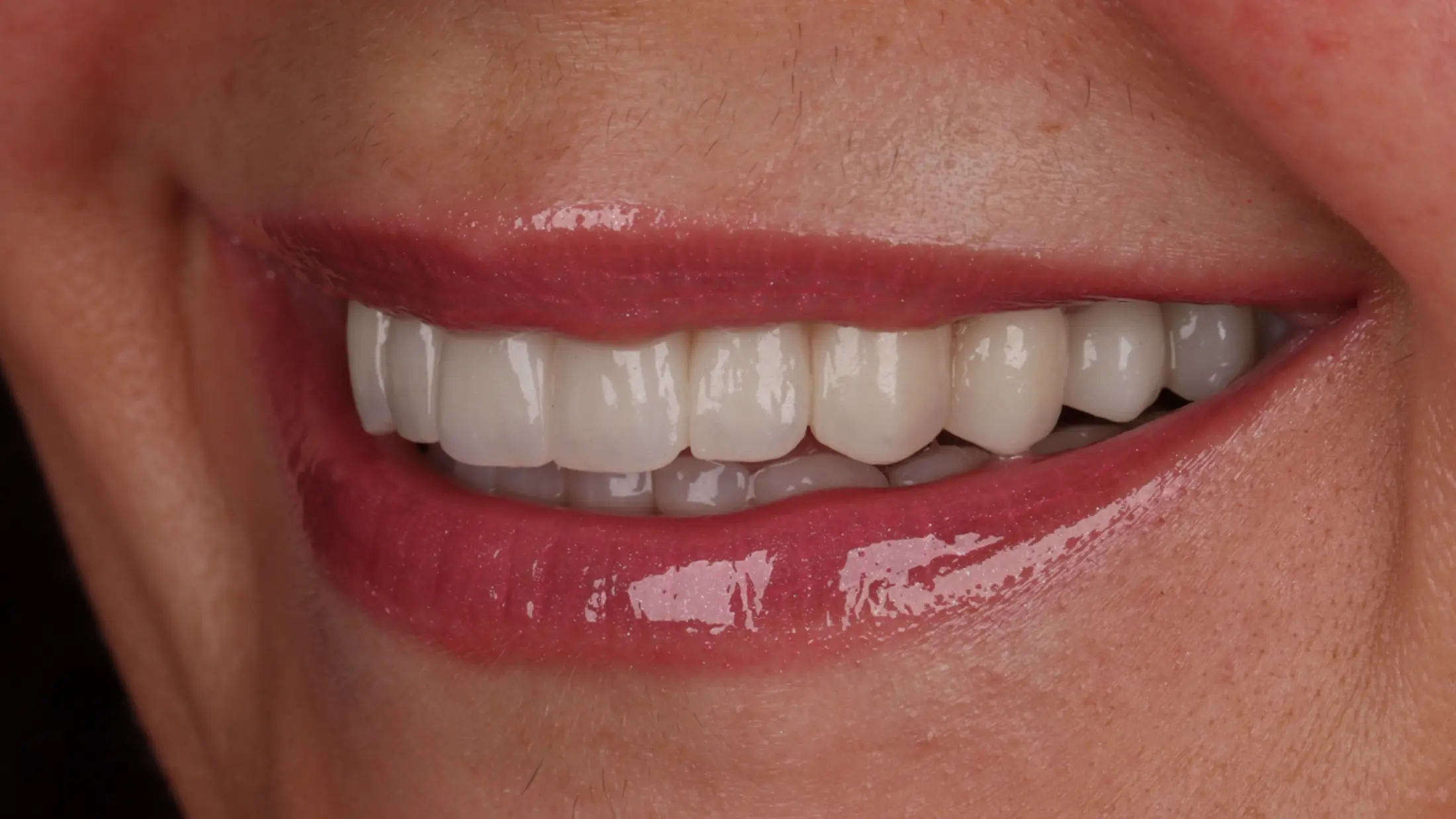Hollywood smile - after treatment