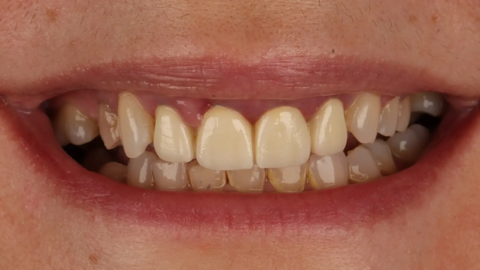 Hollywood smile - before treatment