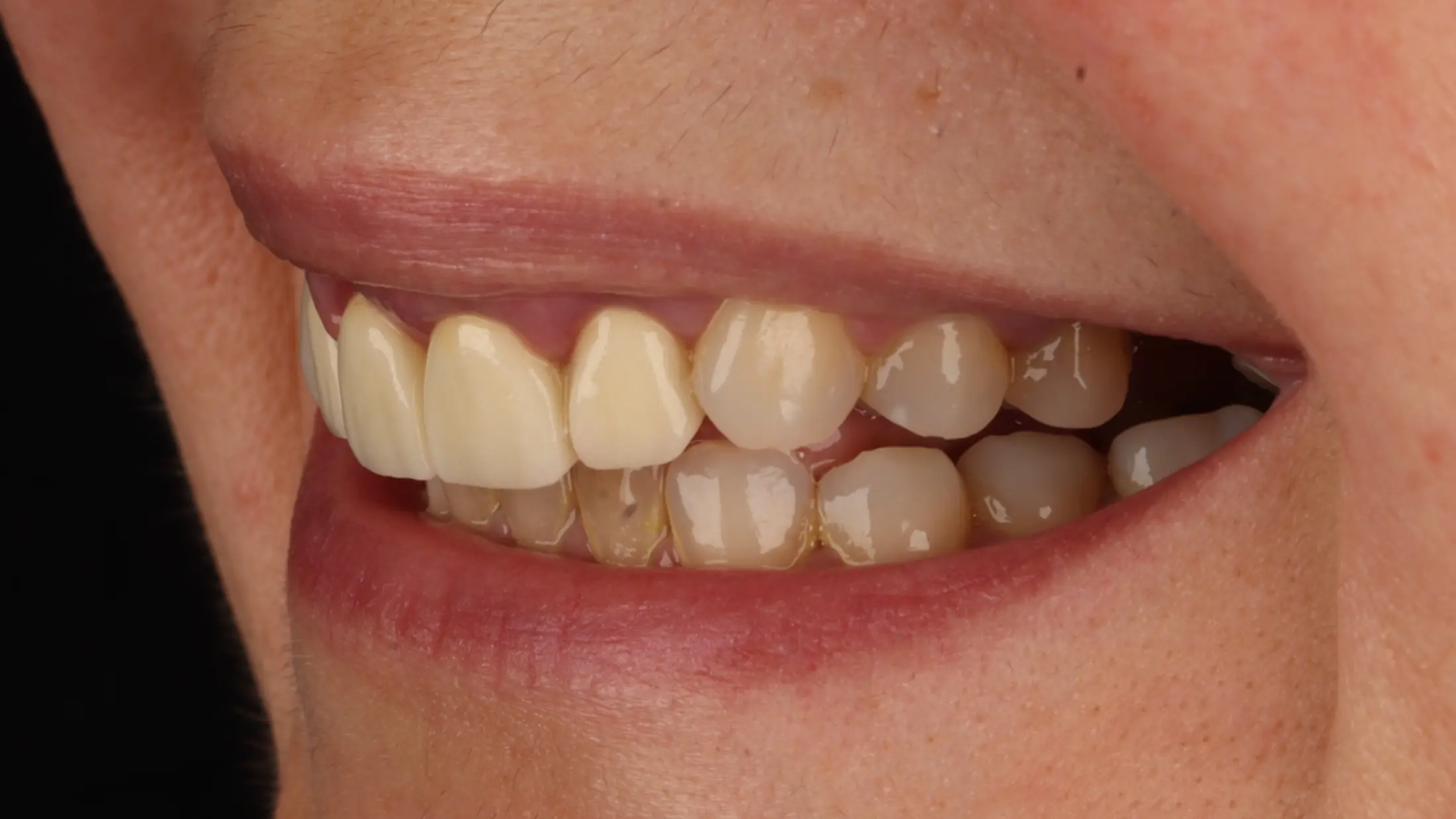 Hollywood smile - before treatment