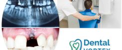 Primer ugrađenih zubnih implanta u vilici na rentgenskom snimku i fotografiji, kao i sam proces snimanja u Dental Vortex-u.